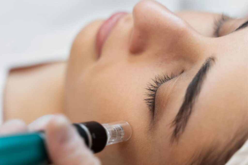 Fotona Micropeel